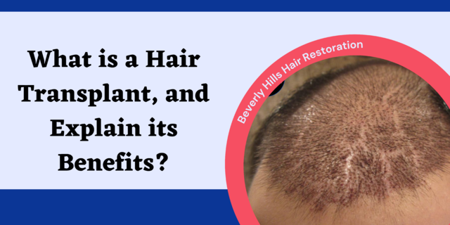 What is a Hair Transplant, and Explain its Benefits?