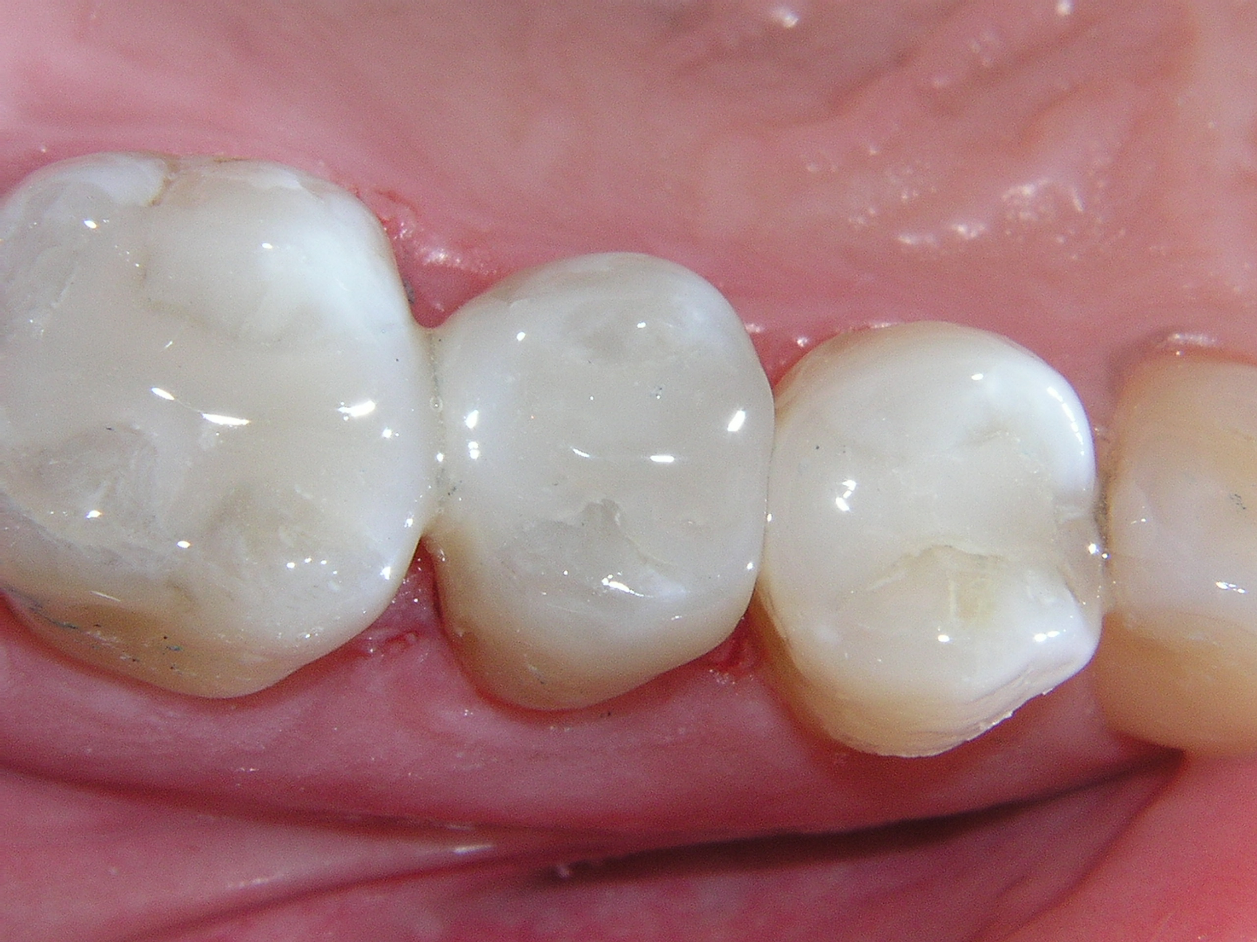 Why Composite Fillings Are The Best Choice For Your Teeth