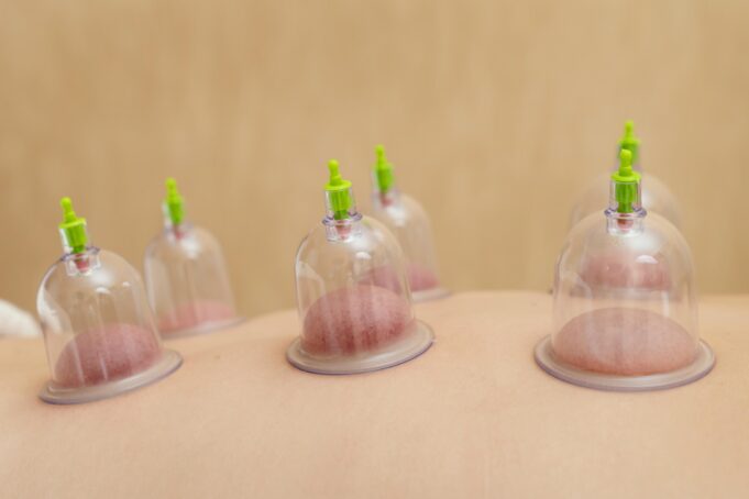 hijama cupping courses