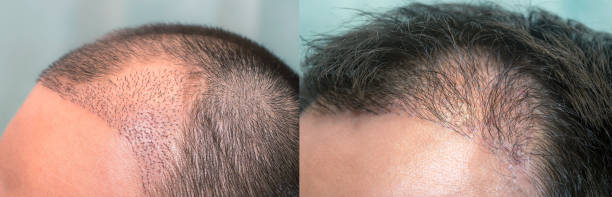Why More and More People Are Getting Hair Transplants in Dubai