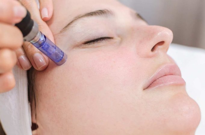 The Radiant Fusion: Unveiling the Magic of Microneedling and RF Microneedling