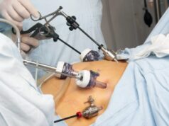 Benefits of Gastric Sleeve Surgery on Diabetes and Hypertension Gastric Sleeve Surgery