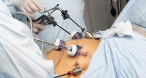 Benefits of Gastric Sleeve Surgery on Diabetes and Hypertension Gastric Sleeve Surgery
