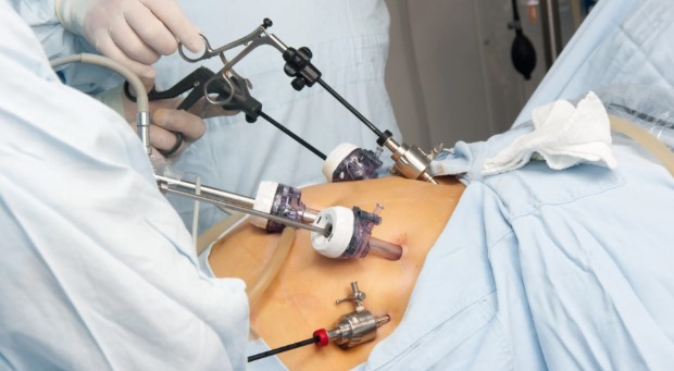 Gastric Sleeve Surgery Benefits for Diabetes & Hypertension Gastric Sleeve Surgery